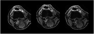 GAE benefits may just be ‘placebo effect’