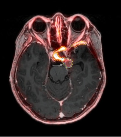 PET improves treatment planning for pituitary tumors