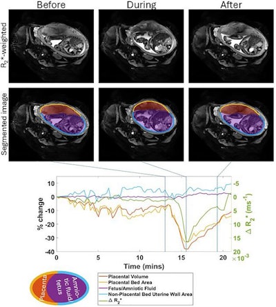 MRI reveals occurrence of placental contractions