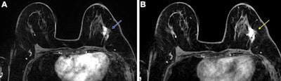 Abbreviated breast MRI after chemotherapy comparable to full protocol