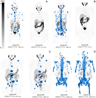 Lu-177 PSMA-SPECT/CT predicts survival in mCRPC