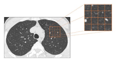 Welding fumes linked to distinct lung CT changes, function