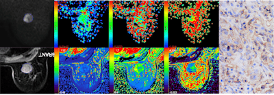 ISMRM: Predictive model evaluates PD-L1 status in breast cancer