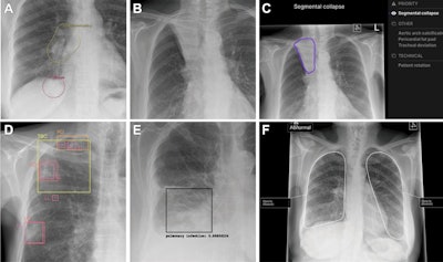 AI devices vary widely in lung cancer detection