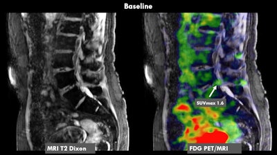 ISMRM: PET/MRI-guided treatment reduces low back pain