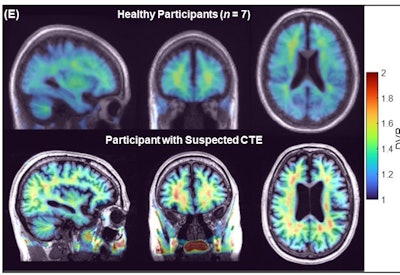 SNMMI: PET tracer detects CTE tau pathology in living patients
