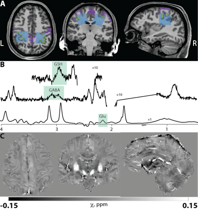 ISMRM: Brain iron accumulation from HIV linked to impeded brain function