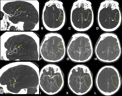CT collateral status may predict outcomes in stroke patients