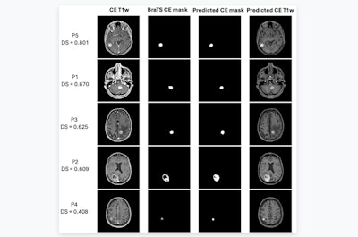 ISMRM: qMRI deep learning model predicts CE in brain tumors