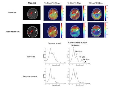 ISMRM: DMI detects treatment response in patients with high-grade gliomas