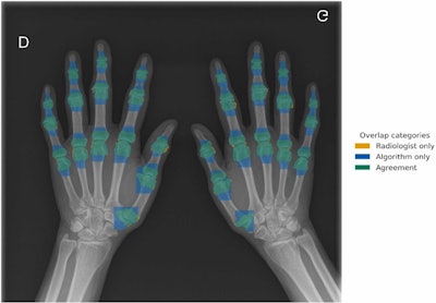 Radiomics model grades hand osteoarthritis on x-rays