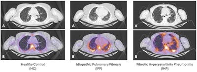 SNMMI: SPECT/CT tracer shows promise in interstitial lung disease