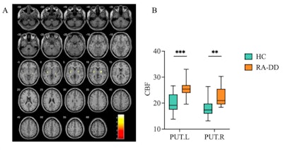 ISMRM: Multimodal MR brain imaging data correlates depression with RA