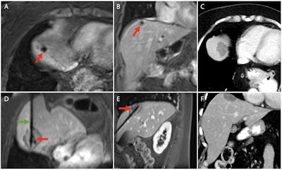 ISMRM: MRI-guided microwave ablation effective for risky liver tumors