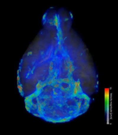 AI-powered MRI technique maps brain fluid flow tied to Alzheimer’s