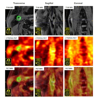ISMRM: PET/MRI highly effective in patients with atherosclerosis