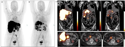 SNMMI: Alpha-emitting tracer offers neuroendocrine tumor treatment option
