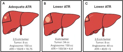 Radiation segmentectomy can be optimized before liver transplant