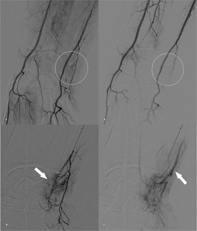 TAE reduces pain in patients with chronic wrist pain