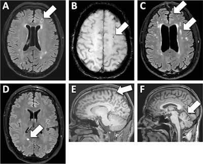 Eye movement abnormalities flag brain health risk in ex-racing drivers