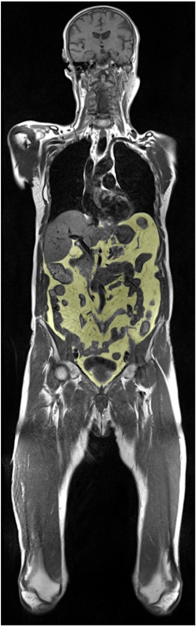 ISMRM: Whole-body MRI links visceral fat to prostate enlargement