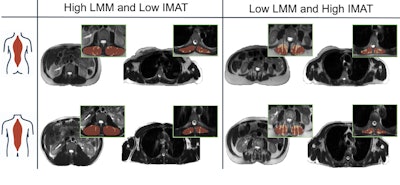 MRI reveals how hidden muscle fat increases risk to heart, metabolism