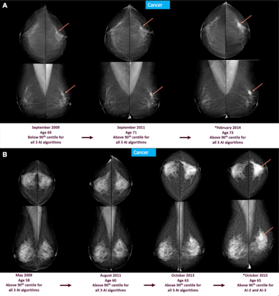 AI may provide early breast cancer alerts from mammograms