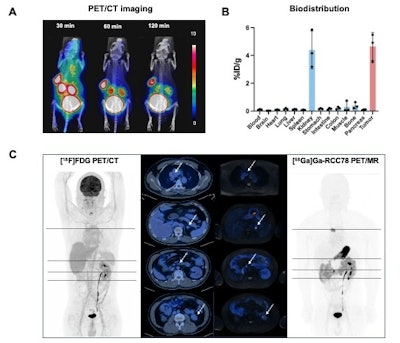 SNMMI: CAIX-targeted PET tracer detects clear cell renal cell carcinoma