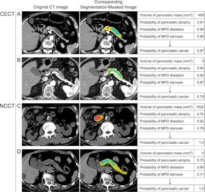 AI models match physicians in pancreatic cancer detection on CT