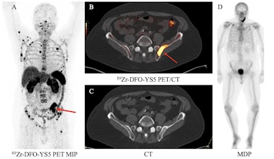 New immuno-PET tracer shows promise in prostate cancer