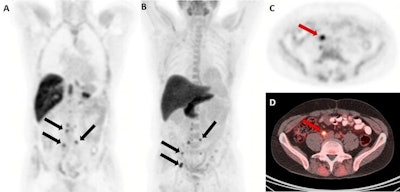 PET/CT guides treatment in men with recurrent prostate cancer
