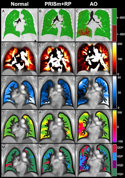 MRI finds perfusion defects across a range of lung impairments