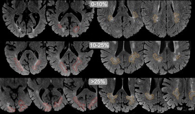 “Dirty” brain white matter shows no link to dementia in older adults