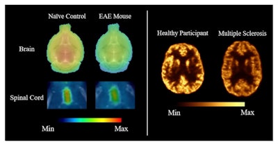 SNMMI: PET reveals new brain activity in multiple sclerosis