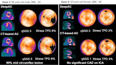 AI-driven cardiac PET attenuation correction shows promise
