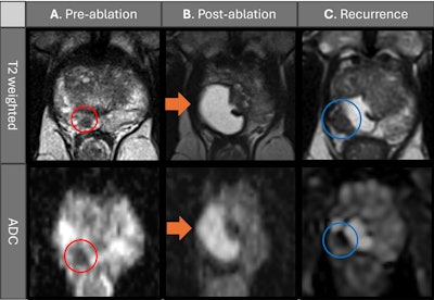 Image-guided focal laser ablation effective for prostate cancer