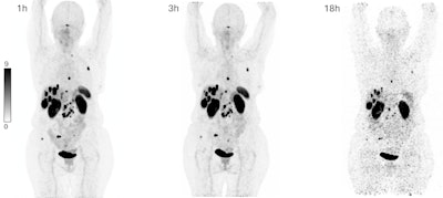 Novel SST2-PET tracer shows promise in patients with NETs