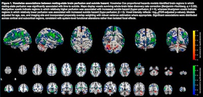 Brain SPECT offers insight into suicide risk