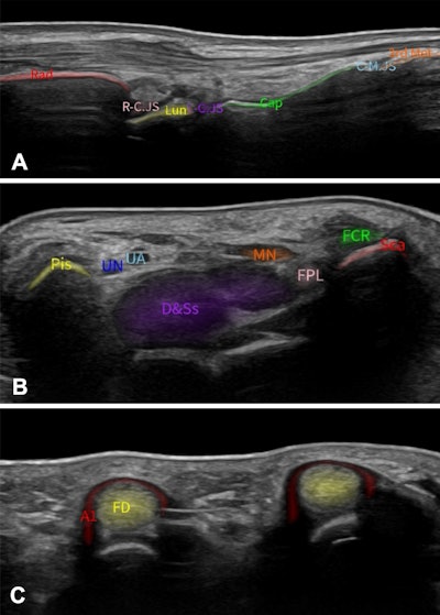 MSK AI tool for ultrasound shows promise for assisting novice imagers
