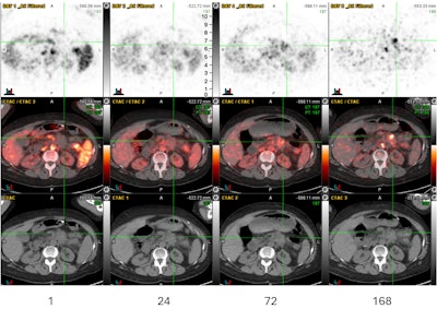 New PET tracer shows promise for guiding pancreatic cancer therapy
