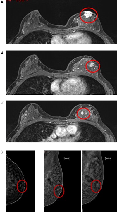 CEM on par with MRI for breast cancer diagnosis, local staging