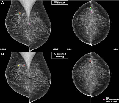 Incorrect AI suggestions influence reader performance on mammography