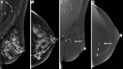 CEM finds breast cancer at baseline, incidence screening