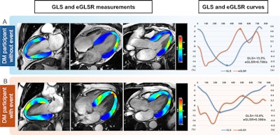 MRI may help predict heart disease risk in patients with diabetes