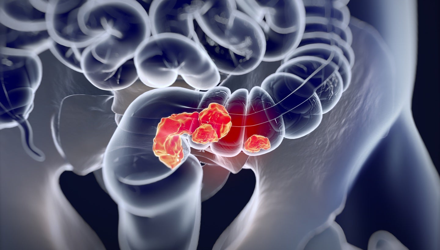 Enrolment concludes in EndoQuest Robotics’ PARADIGM study
