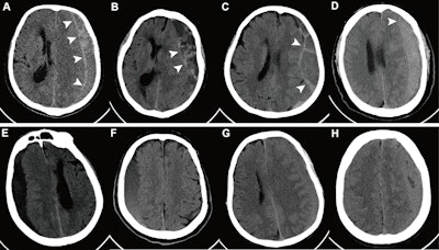 CT sign may flag who benefits from subdural hematoma procedure