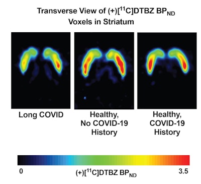 Brain PET scans reveal neuron loss in long COVID