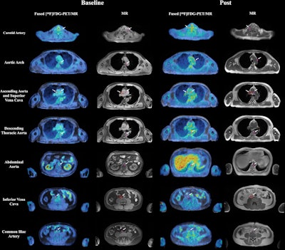 PET/MRI detects arterial inflammation in prostate cancer patients