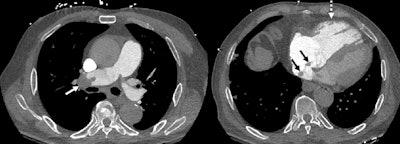 ACR rolls out PE-RADS for pulmonary embolism care