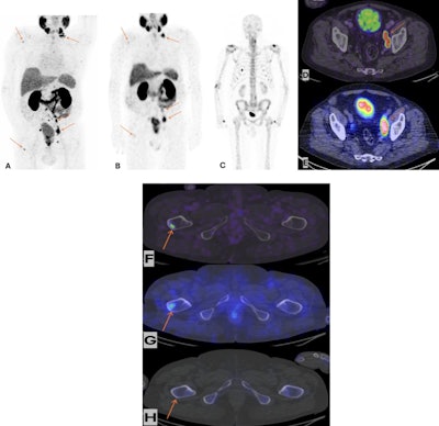SPECT/CT viable over PET/CT for high-risk prostate cancer staging